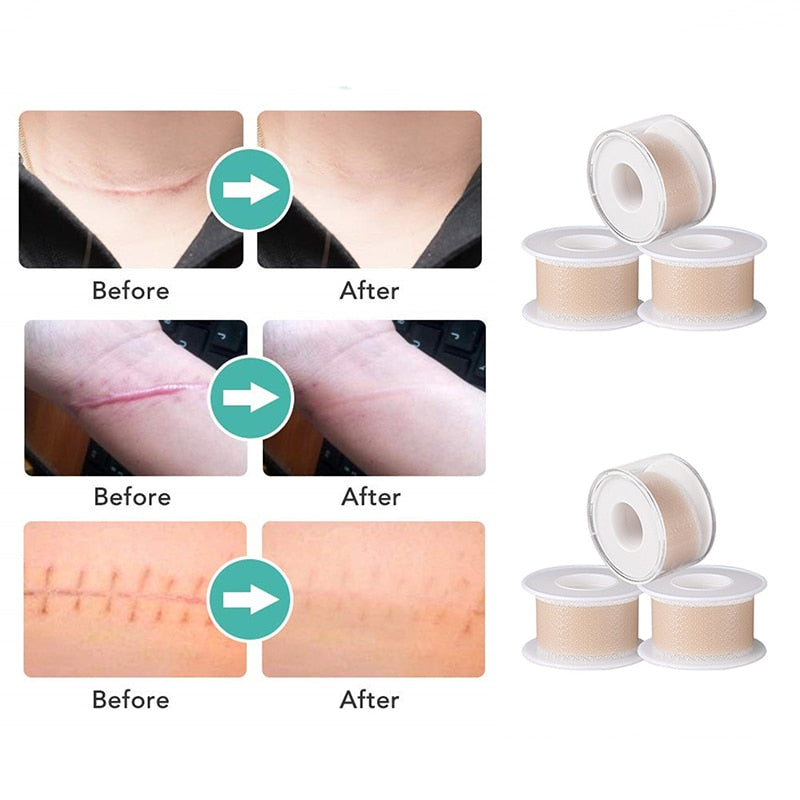 Results of Healing Silicone Gel Scar Removal Film Tape